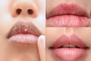 WINTER CHAPPED LIPS REMEDY