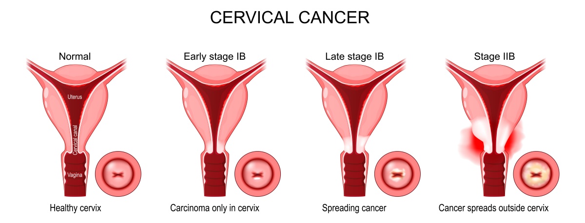 Stages of cervical cancer