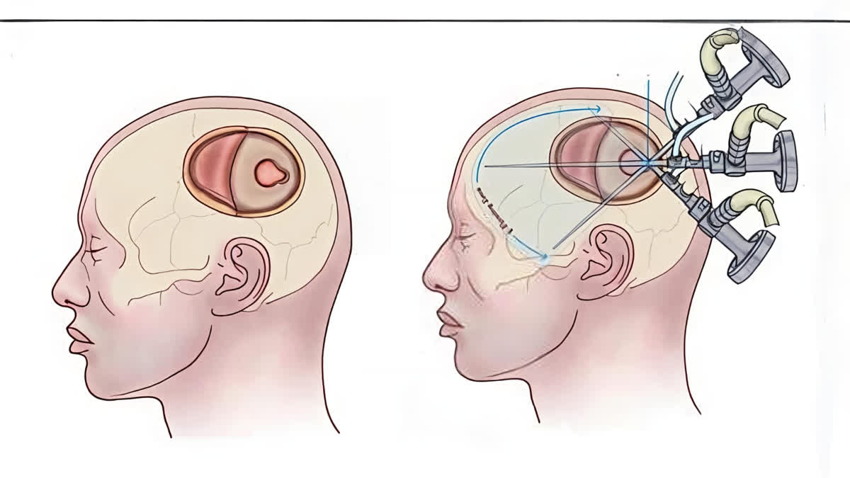 Chennai Doctors Develop New Surgery Technique Kilpauk Keyhole Craniotomy For Brain Haemorrhage
