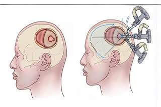 Chennai Doctors Develop New Surgery Technique Kilpauk Keyhole Craniotomy For Brain Haemorrhage