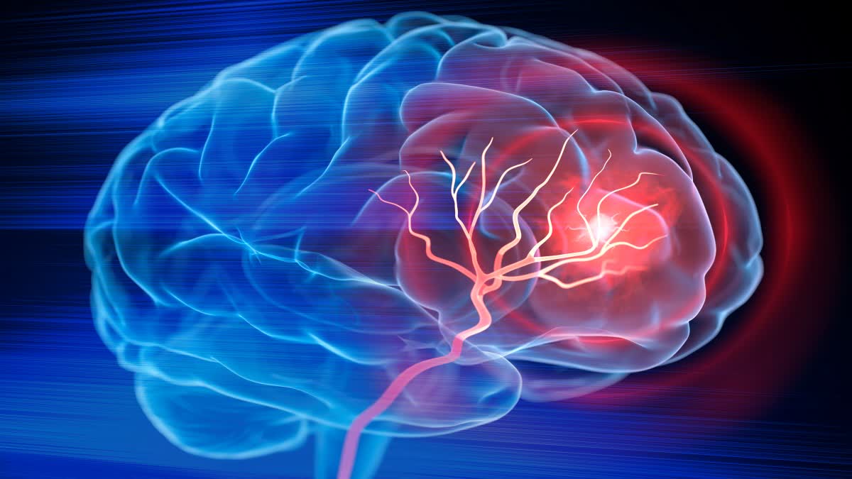 Brain Tumour