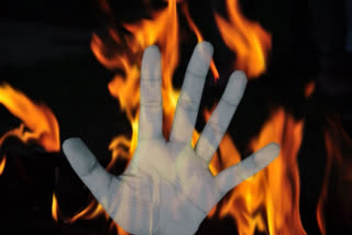 31-Year-Old Woman From Odisha's Pipili Suffers 90% Burns, Admitted To Bhubaneswar Hospital