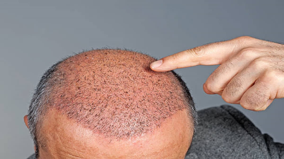 Baldness or hair loss (alopecia) is a common among men and women and there are various factors responsible for it including stress and heredity