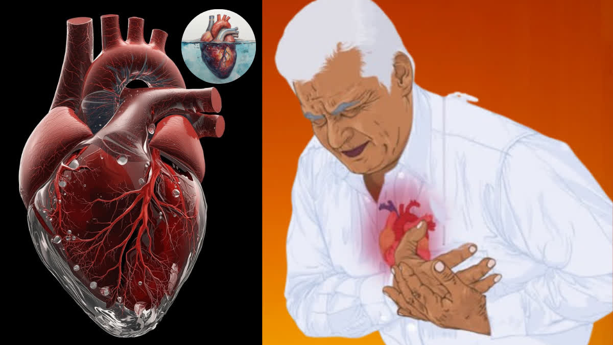Fluid buildup in the heart can also cause a heart attack; learn who is at risk of serious pericardial effusion