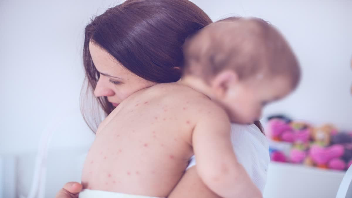 Baby with measles