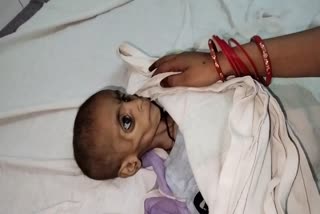SHIVPURI GIRL DIES MALNUTRITION