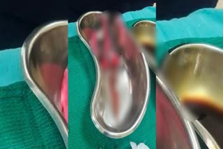 rare and complex surgery  scissors pierced the chest  surgery department  sreejayan rajankumar