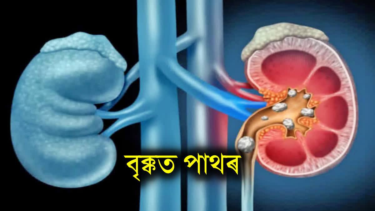 CAUSES OF KIDNEY STONES