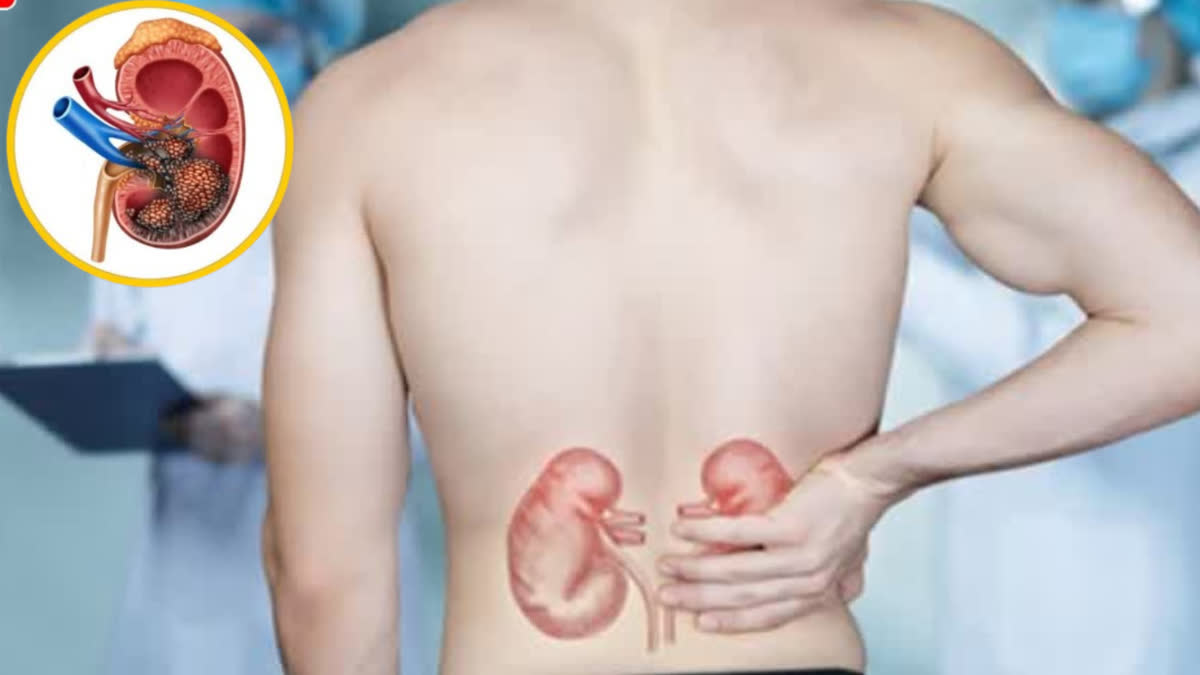 Learn in detail about the warning signs, symptoms, types, and risk factors of kidney cancer.
