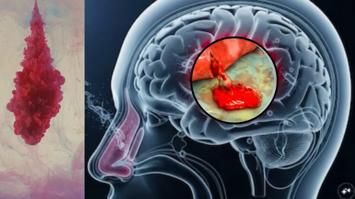 انسان کے دماغ کی رگ کب پھٹتی ہے؟ ان 12 ابتدائی علامات کو نظر انداز نہ کریں، ورنہ آپ اپنی جان سے ہاتھ دھو سکتے ہیں