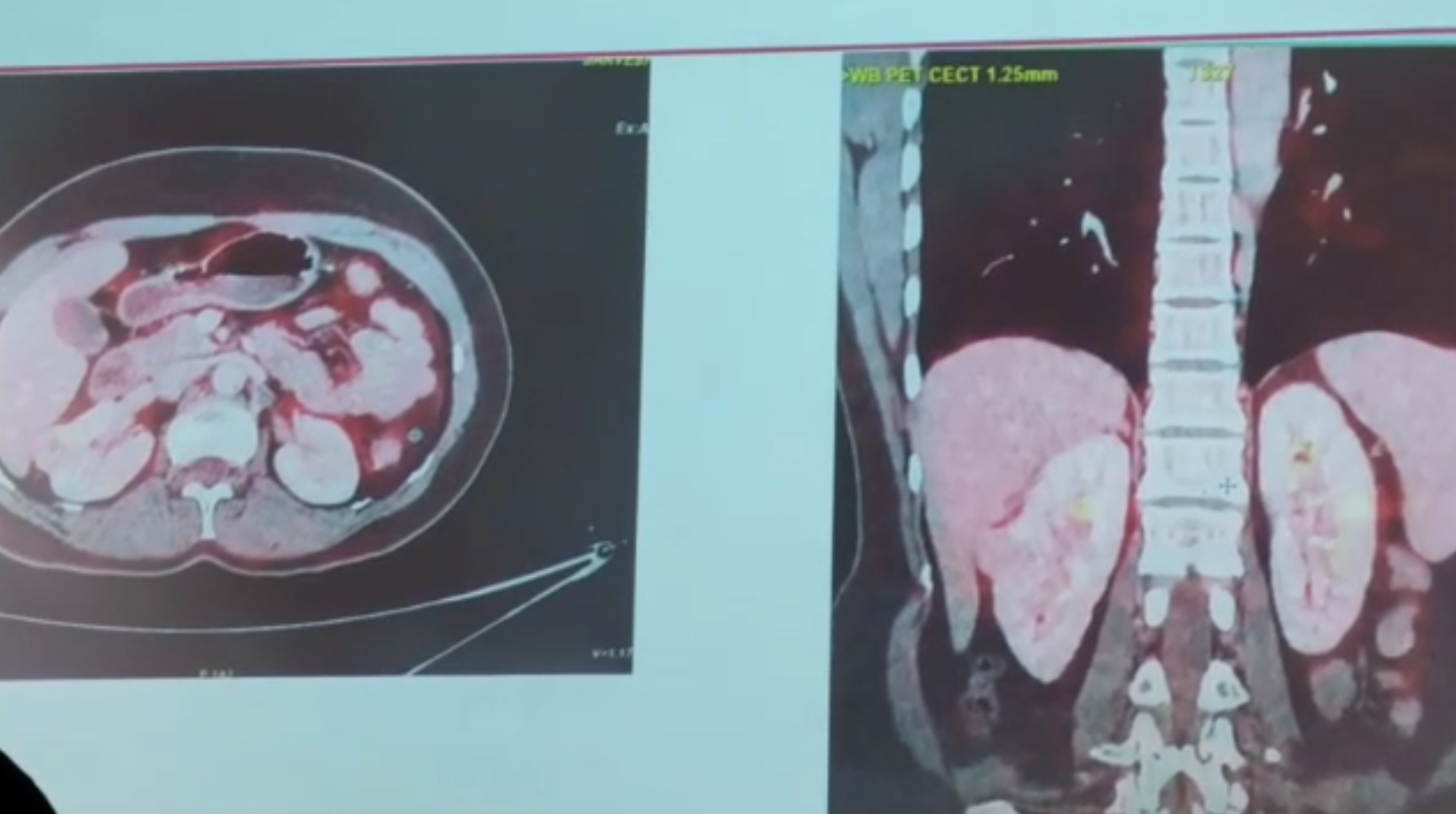 Haryana Faridabad Doctors performed the first tele robotic surgery in a private hospital in Kolkata from 1500 km Distance