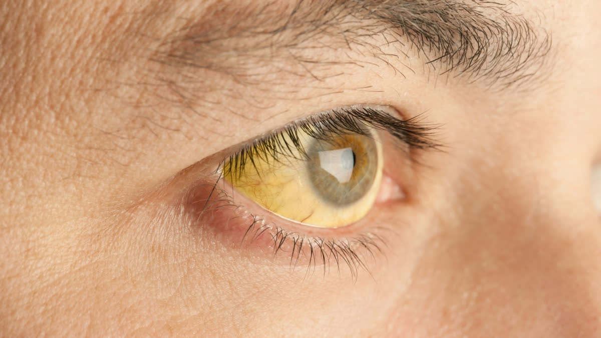 World Liver Day 2025: What Your Eyes Say About Your Liver: Don't Ignore These Early Signs The most common and noticeable first sign of liver problems is jaundice, where the whites of your eyes turn yellow (Representational Image)