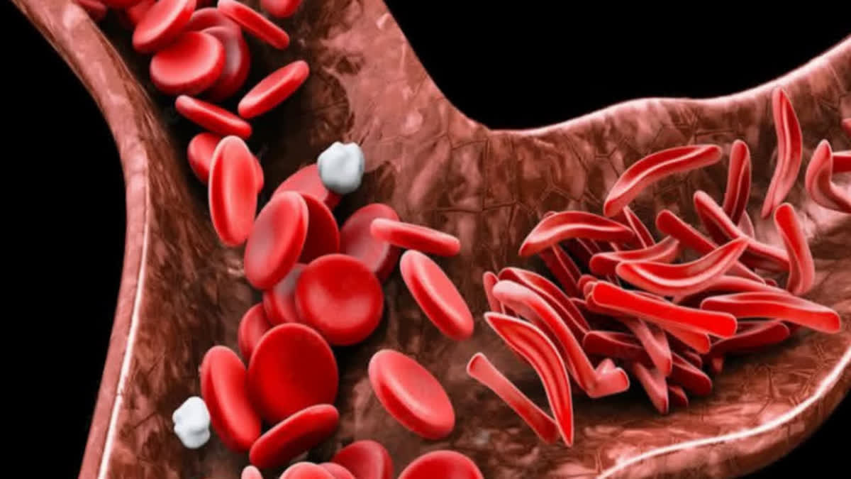 Status and challenges of sickle cell disease in India; how new gene therapy is effective for treatment.