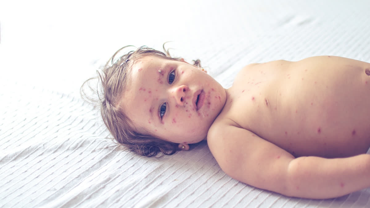 RUBELLA OUTBREAK IN BANGLADESH  MEGHALAYA ON ALERT  RUBELLA OUTBREAK  ದಡಾರ ಮತ್ತು ರುಬೆಲ್ಲಾ ಪ್ರಕರಣಗಳು ಏರಿಕೆ