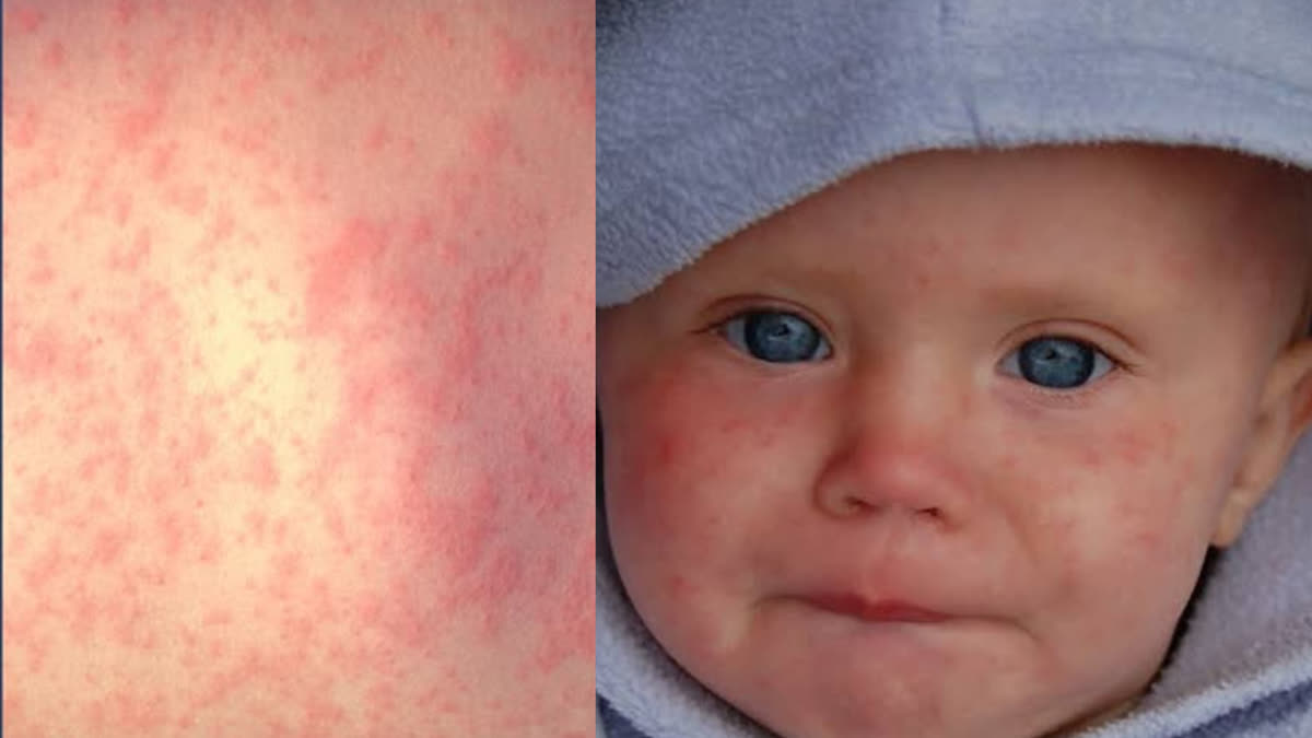 RUBELLA OUTBREAK IN BANGLADESH  MEGHALAYA ON ALERT  RUBELLA OUTBREAK  ದಡಾರ ಮತ್ತು ರುಬೆಲ್ಲಾ ಪ್ರಕರಣಗಳು ಏರಿಕೆ