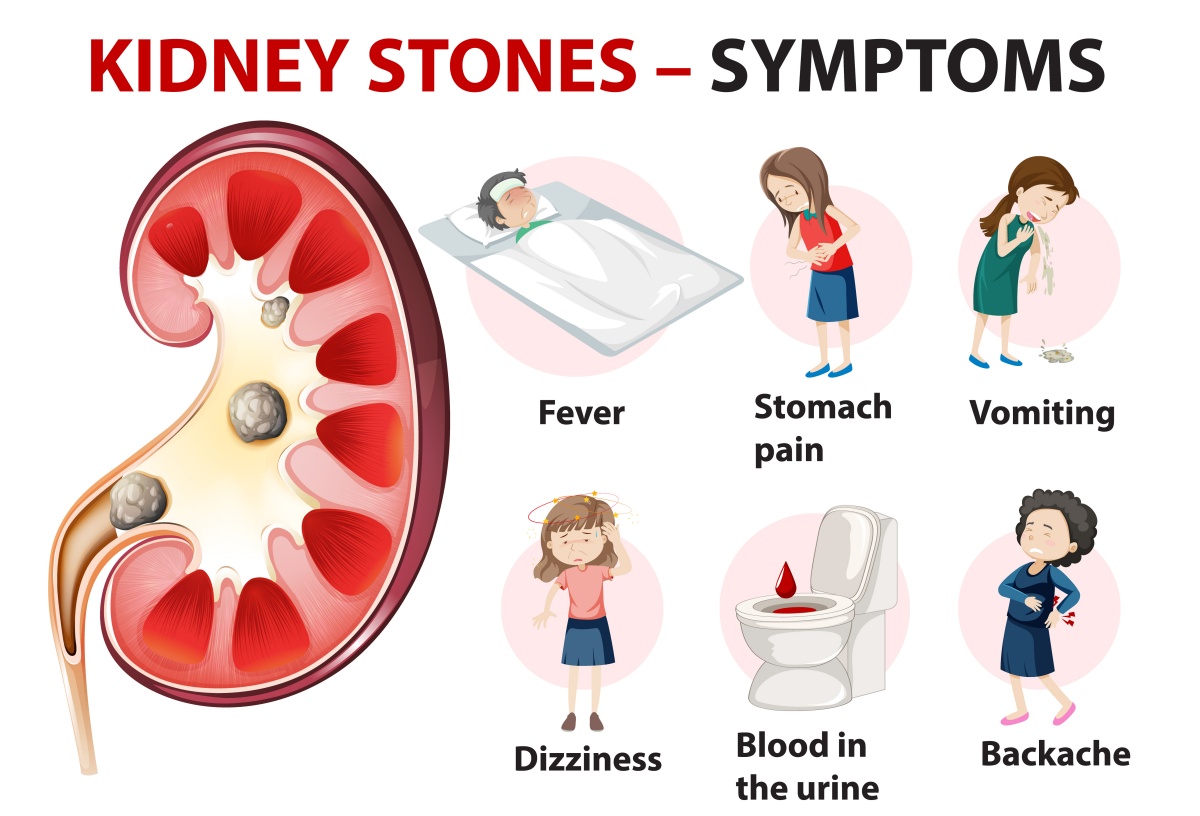 Reasons for the spike in kidney stones during summer