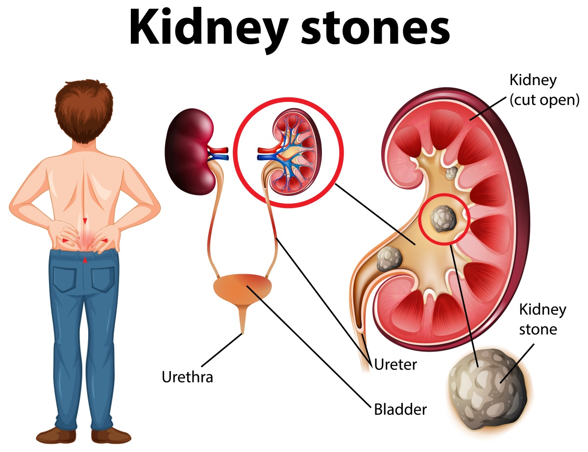 Reasons for the spike in kidney stones during summer