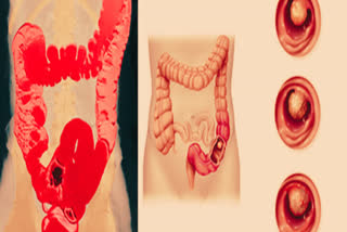POOR GUT INCREASES RISK OF CANCER