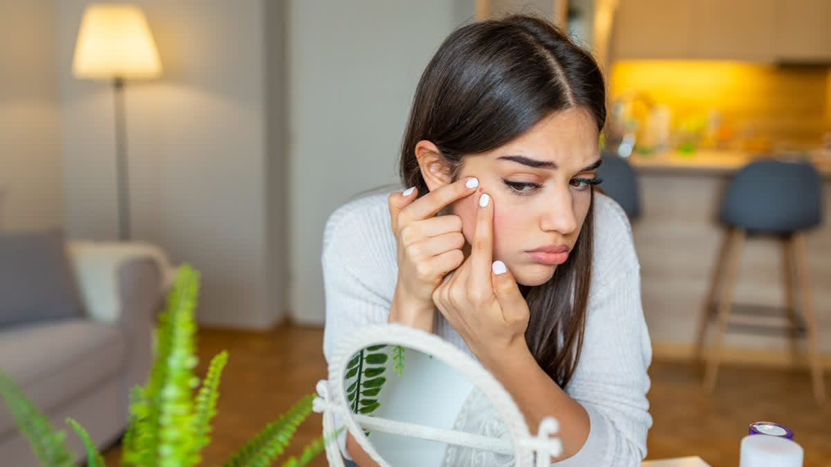 Sensitive Skin Problems Are On The Rise, Are Pollution, Stress And Bad Products To Blame? We Asked A Dermat Girl with acne