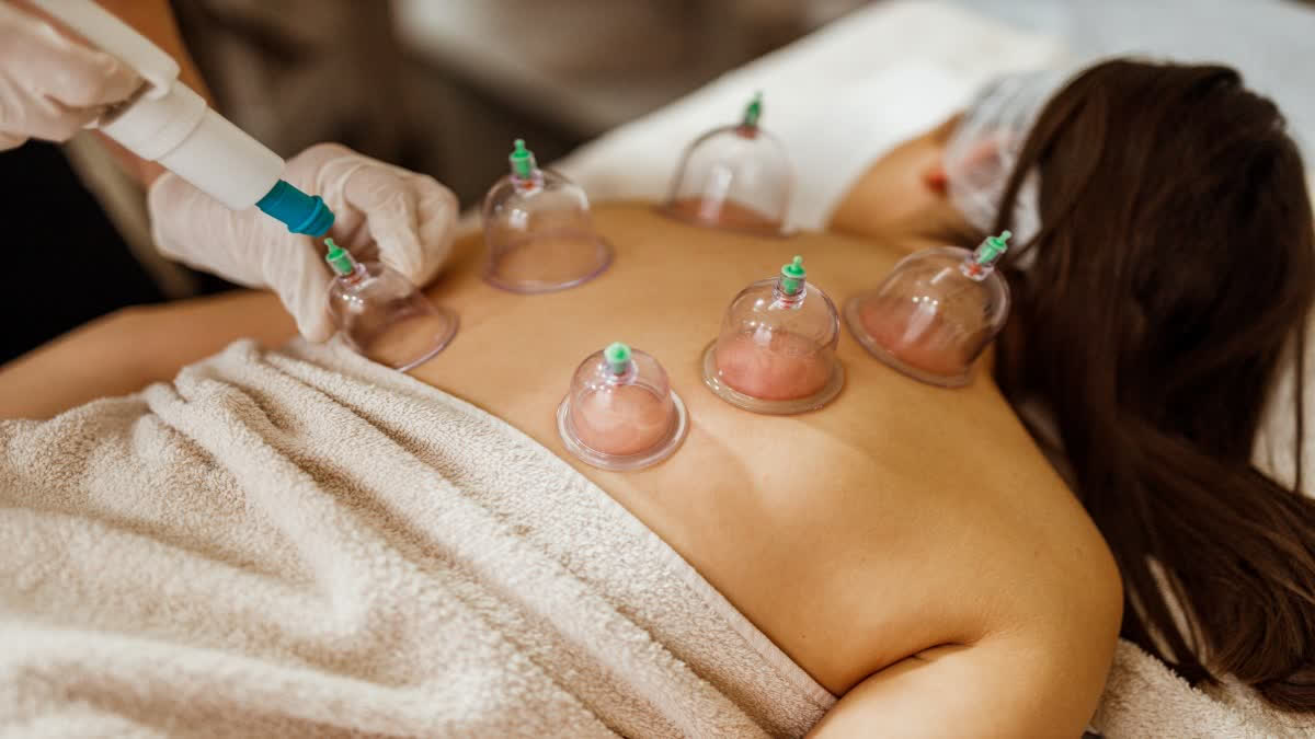 CUPPING THERAPY BENEFITS  CUPPING THERAPY GIVES RELIEF  CUPPING THERAPY Health BENEFITS  ಕಪ್ಪಿಂಗ್ ಥೆರಪಿ