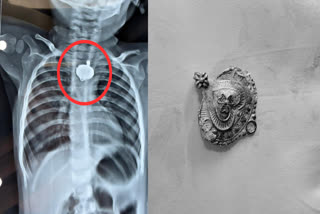 Barwani food pipe Mangalsutra stuck