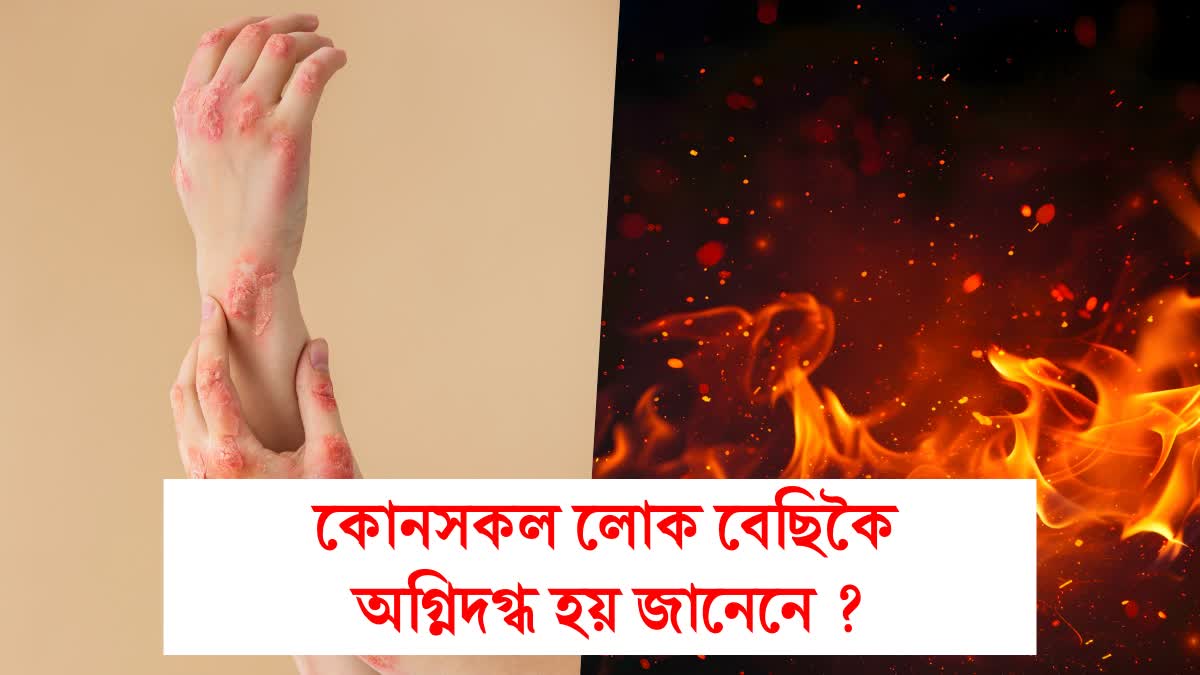BURN RISK FACTORS