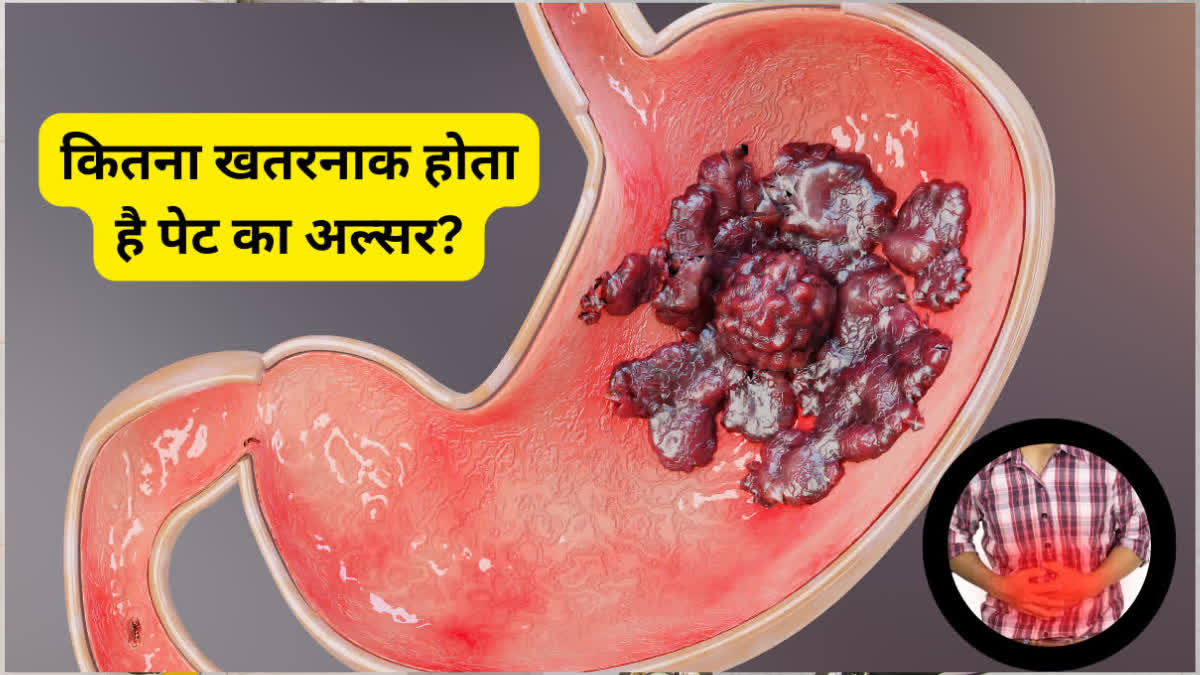 पेट का अल्सर क्यों और कैसे होता है? जानें इसके लक्षण और बचने के उपाय