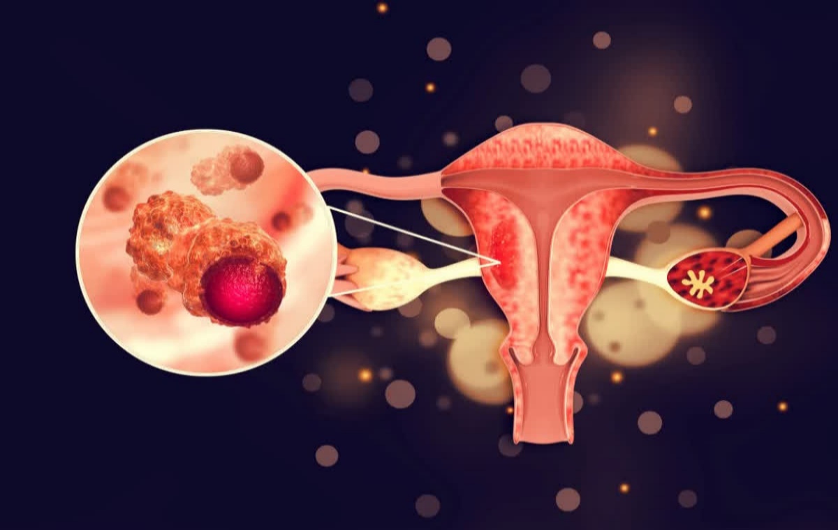Ovarian cancer
