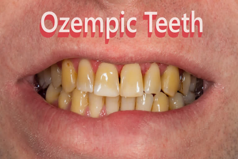 Ozempic Teeth' Signals Need For Greater Awareness Of Weight Loss Drugs, Say Dentists