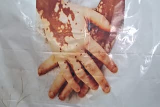 World Vitiligo Day 2025