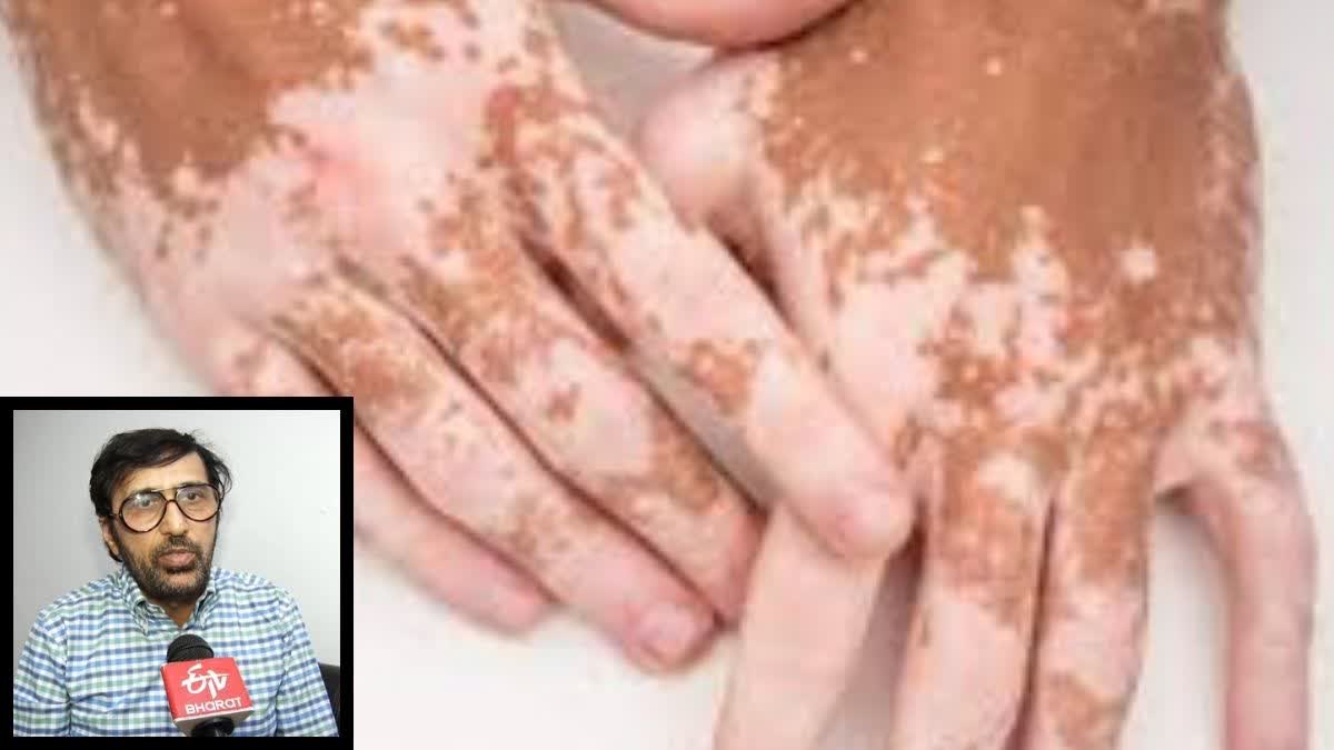 World Vitiligo Day 2026