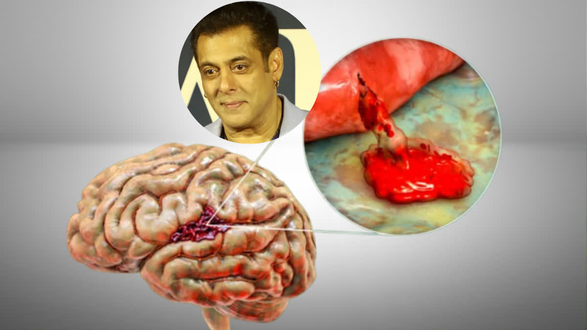 Salman Khan suffers from brain aneurysm problem, know the cause, symptoms and treatment of this condition