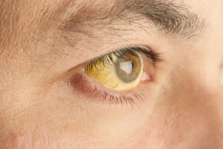 EARLY SIGNS OF JAUNDICE