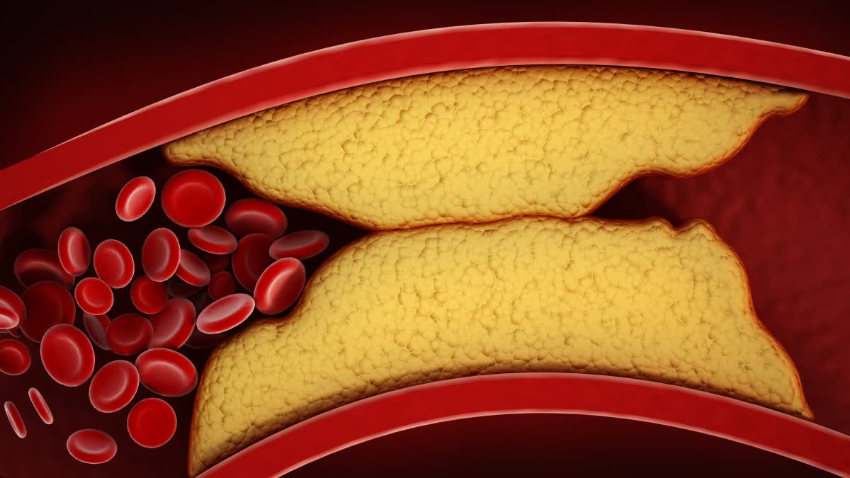 These daily habits raise bad cholesterol levels in the body; learn about home remedies to lower LDL.