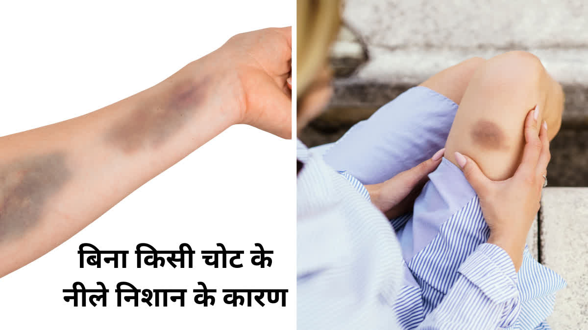 Do you get blue marks on your body without any injury? Then know what is Bruise.
