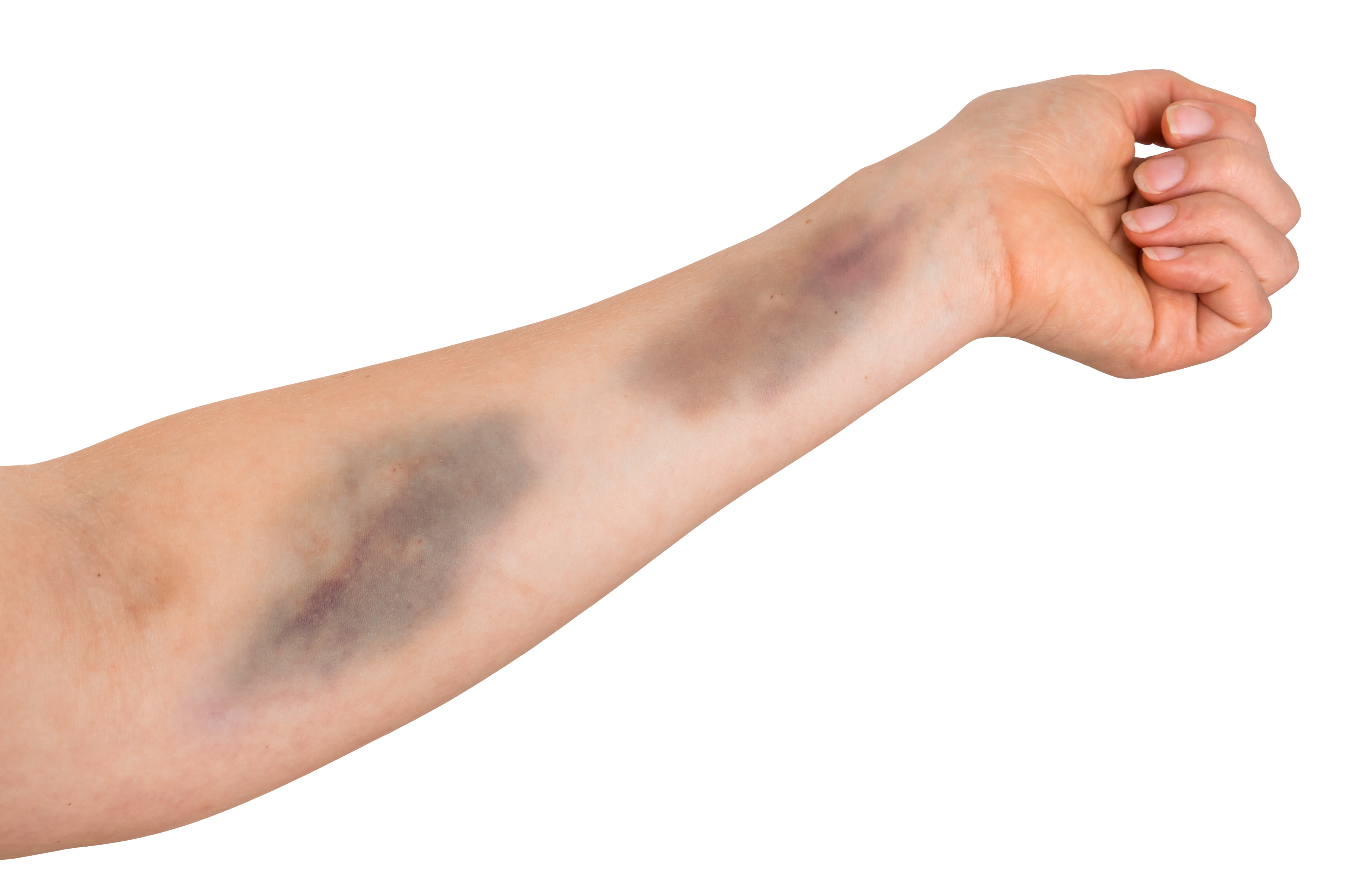 Do you get blue marks on your body without any injury? Then know what is Bruise.