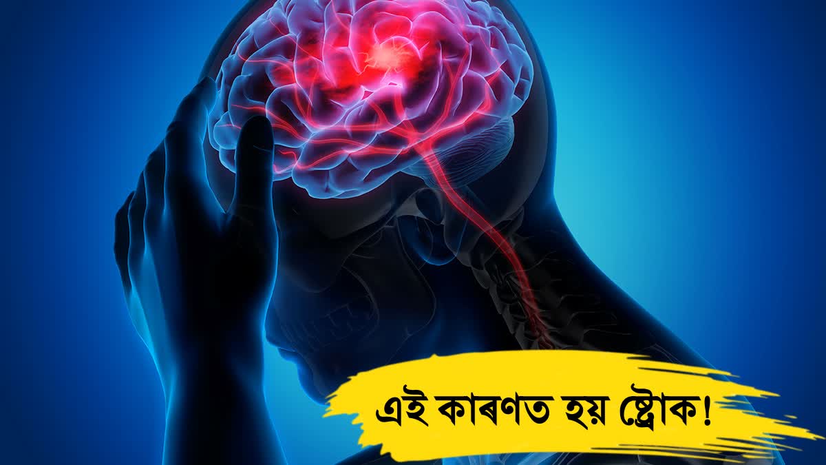 Rising Stroke Cases Among Young Adults