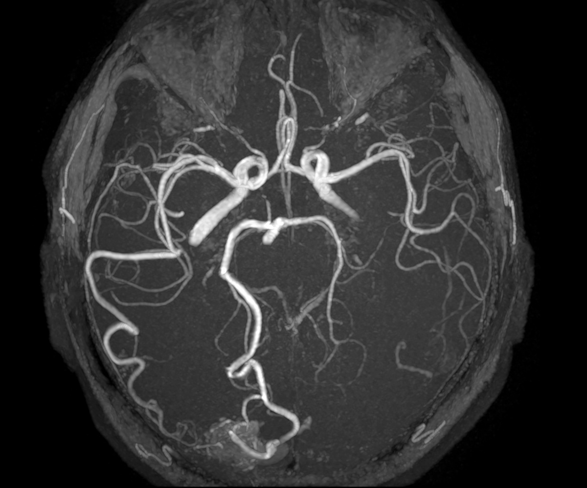 World Stroke Day 2026: All About AVMs And Brain Haemorrhage