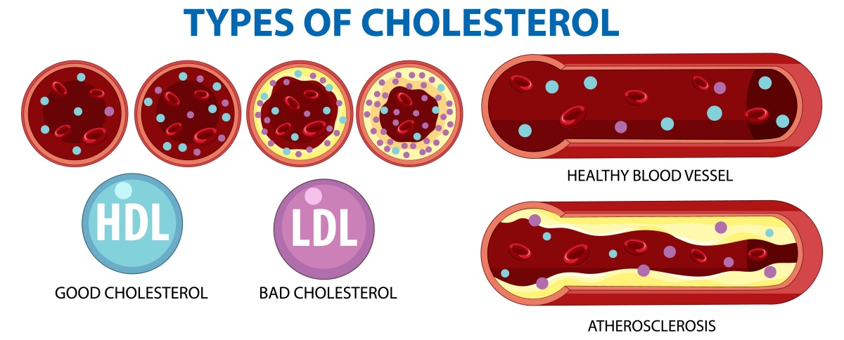 Good cholesterol and bad cholesterol