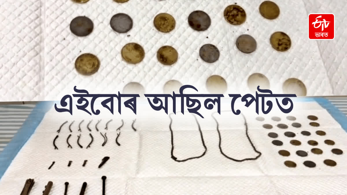 43 objects, including 23 coins, swallowed by boy safely removed from stomach