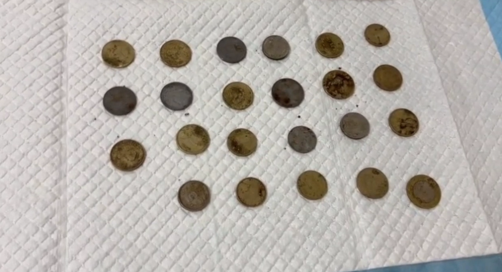 43 objects, including 23 coins, swallowed by boy safely removed from stomach