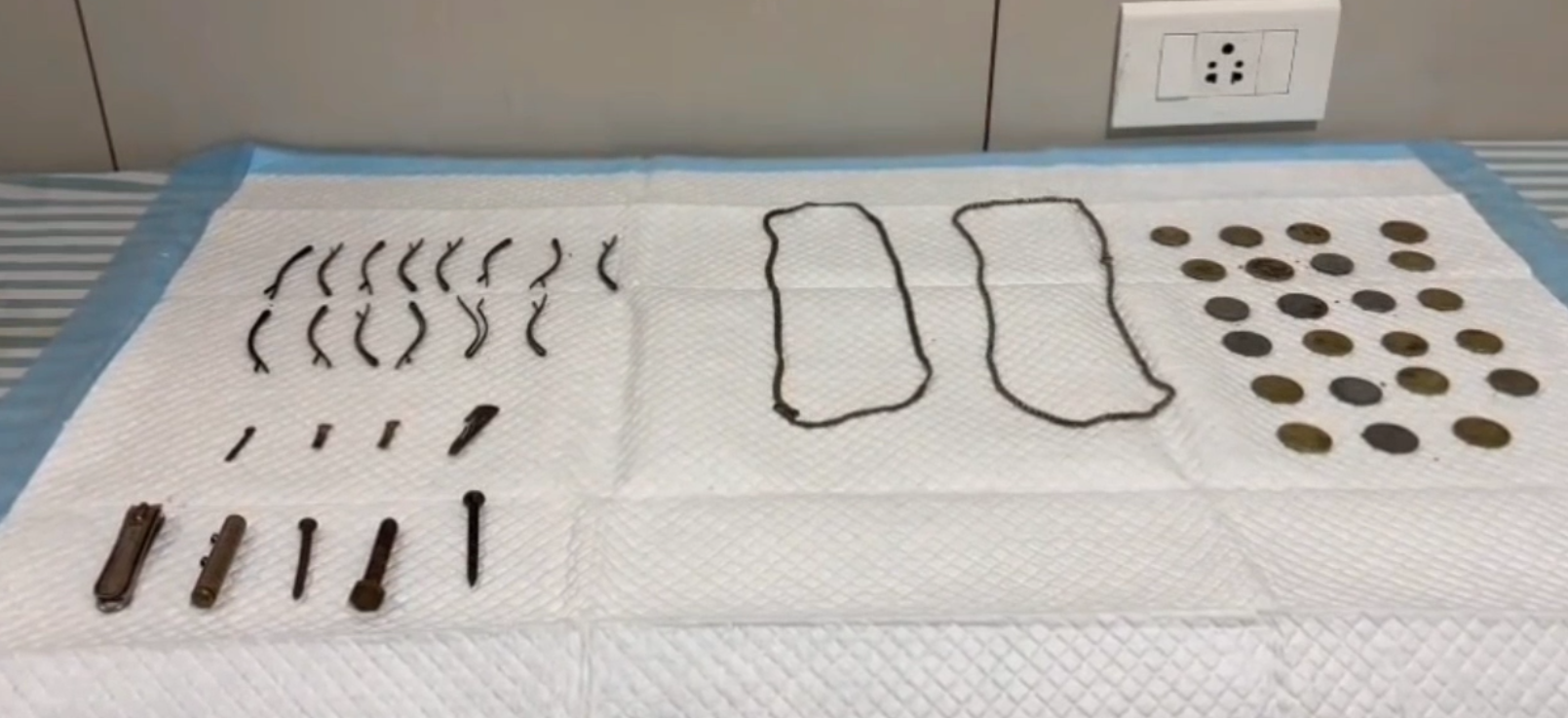 43 objects, including 23 coins, swallowed by boy safely removed from stomach
