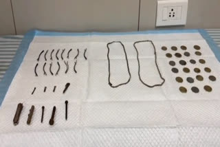 43 metal objects including 23 coins were removed from the boy's stomach.