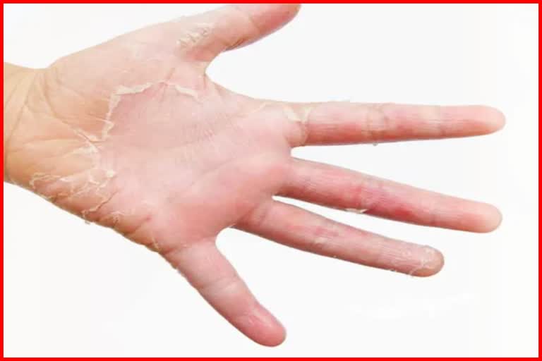 Fungal Infection : फंगल इन्फेक्शनने ग्रस्त असल्यास करा 'हे' उपाय